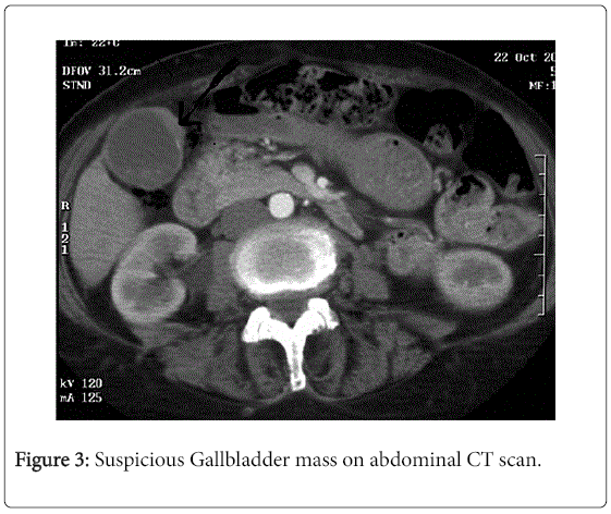 gastrointestinal-digestive-system-Gallbladder-mass