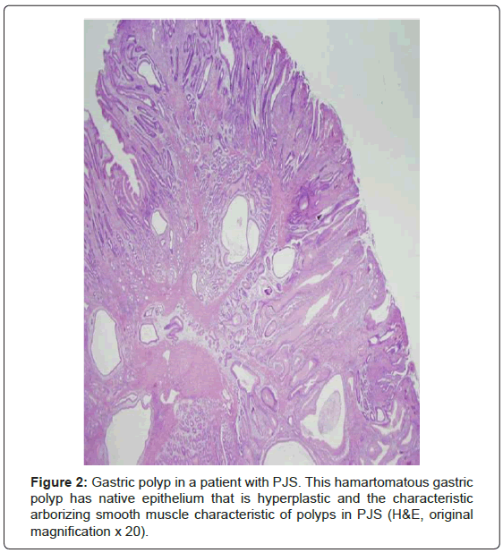 gastrointestinal-digestive-system-Gastric-polyp