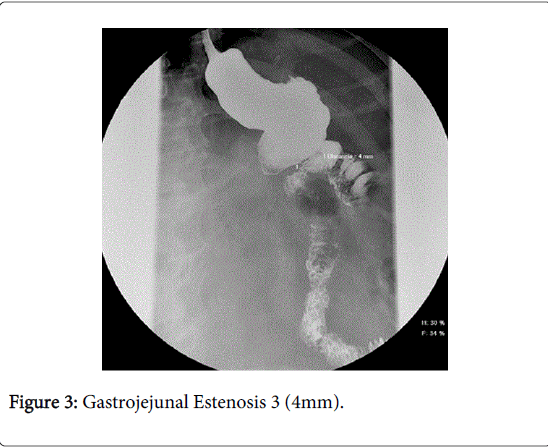 gastrointestinal-digestive-system-Gastrojejunal-Estenosis