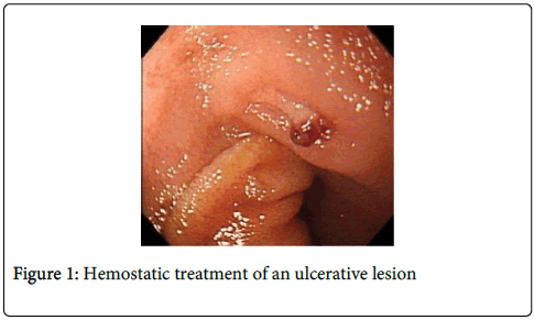 gastrointestinal-digestive-system-Hemostatic-treatment