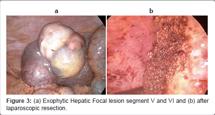 gastrointestinal-digestive-system-Hepatic-Focal