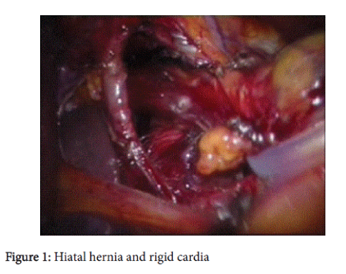gastrointestinal-digestive-system-Hiatal-hernia