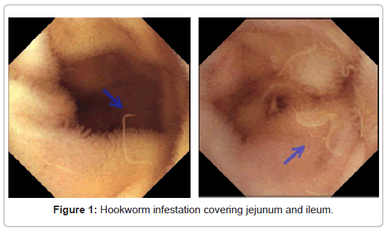 gastrointestinal-digestive-system-Hookworm-infestation