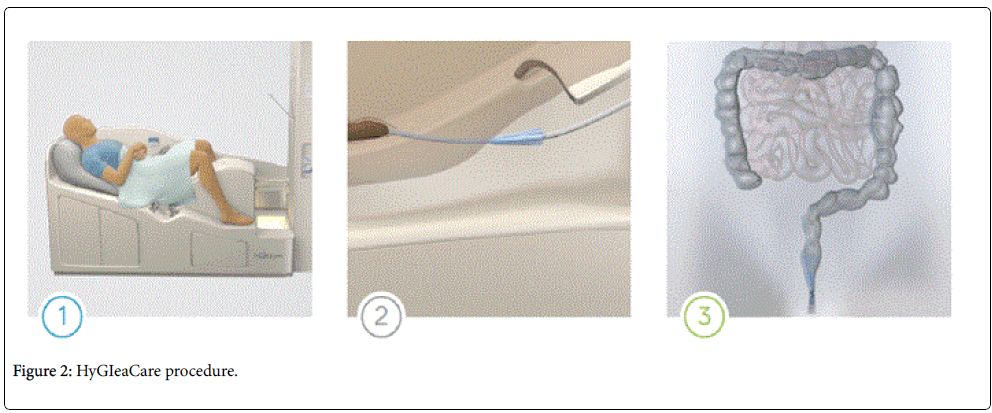 gastrointestinal-digestive-system-HyGIeaCare-procedure