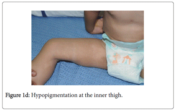gastrointestinal-digestive-system-Hypopigmentation-inner-thigh