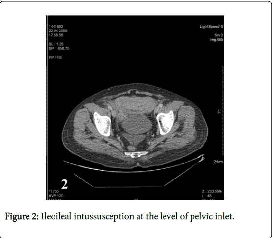 gastrointestinal-digestive-system-Ileoileal-intussusception