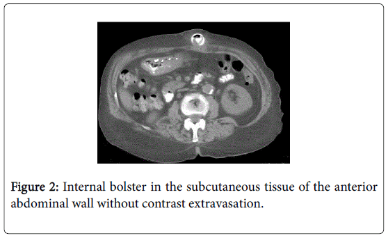 gastrointestinal-digestive-system-Internal-bolster