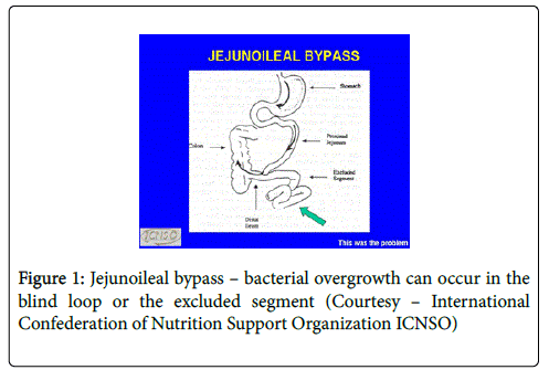 gastrointestinal-digestive-system-Jejunoileal-bypass
