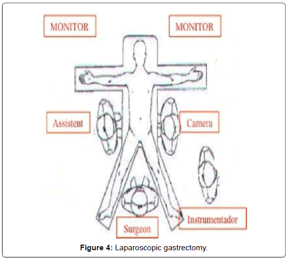 gastrointestinal-digestive-system-Laparoscopic-gastrectomy