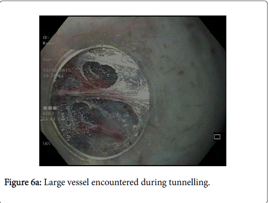 gastrointestinal-digestive-system-Large-vessel