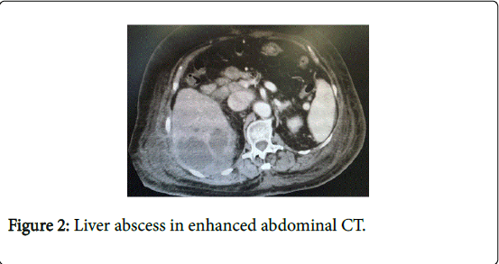 gastrointestinal-digestive-system-Liver-abscess