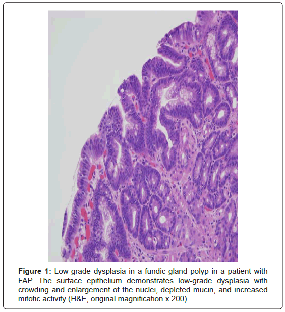gastrointestinal-digestive-system-Low-grade