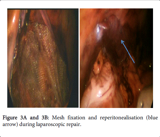 gastrointestinal-digestive-system-Mesh-fixation