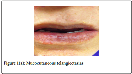 gastrointestinal-digestive-system-Mucocutaneous-telangiectasias