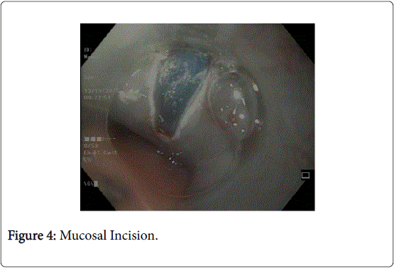 gastrointestinal-digestive-system-Mucosal-Incision