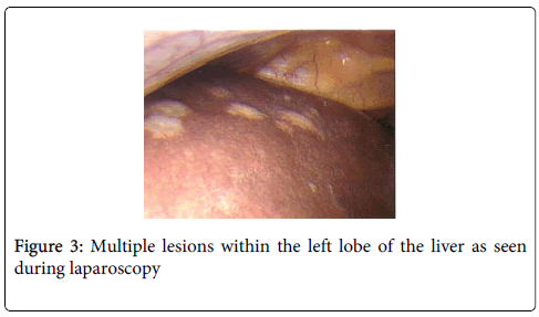gastrointestinal-digestive-system-Multiple-lesions