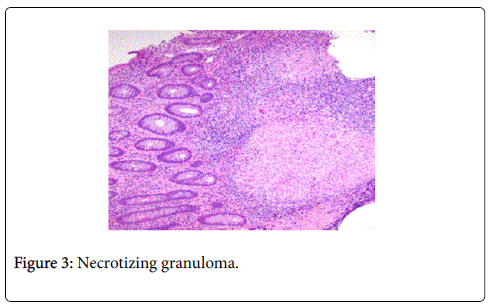 gastrointestinal-digestive-system-Necrotizing-granuloma