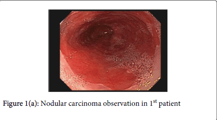 gastrointestinal-digestive-system-Nodular-carcinoma