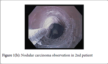 gastrointestinal-digestive-system-Nodular-carcinoma