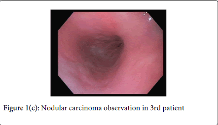gastrointestinal-digestive-system-Nodular-carcinoma