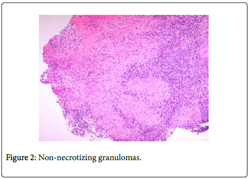 gastrointestinal-digestive-system-Non-necrotizing
