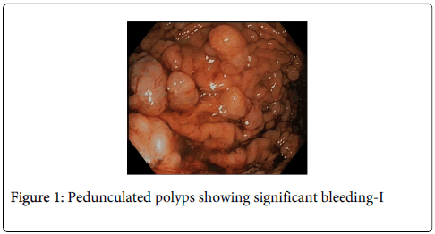 gastrointestinal-digestive-system-Pedunculated-polyps