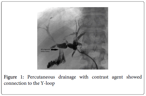 gastrointestinal-digestive-system-Percutaneous-drainage