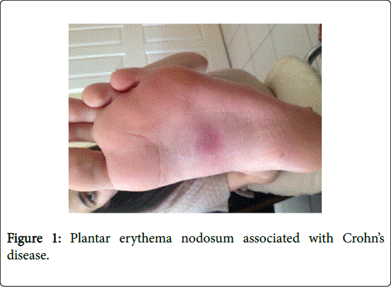 gastrointestinal-digestive-system-Plantar-erythema