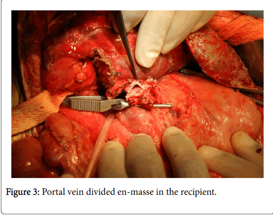 gastrointestinal-digestive-system-Portal-vein