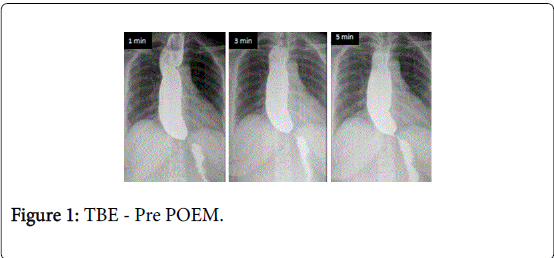 gastrointestinal-digestive-system-Pre-POEM