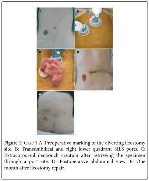 gastrointestinal-digestive-system-Preoperative-marking