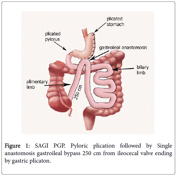 gastrointestinal-digestive-system-Pyloric-plication