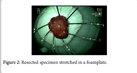 gastrointestinal-digestive-system-Resected-specimen