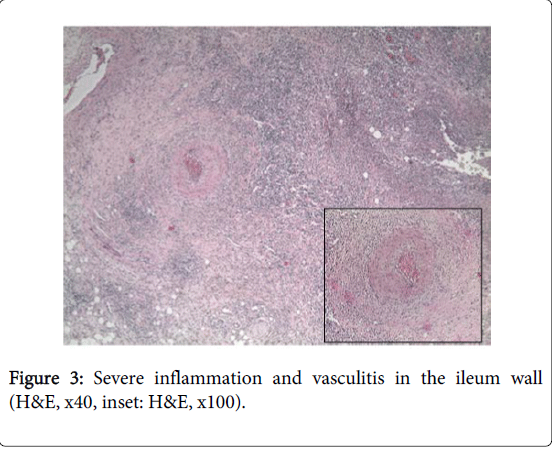gastrointestinal-digestive-system-Right-hemicolectomy