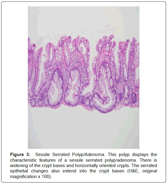 gastrointestinal-digestive-system-Sessile-Serrated