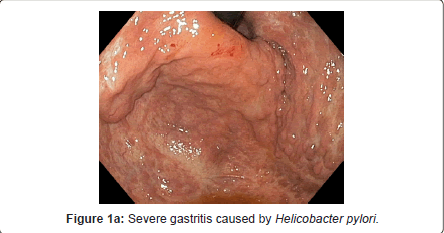 gastrointestinal-digestive-system-Severe-gastritis