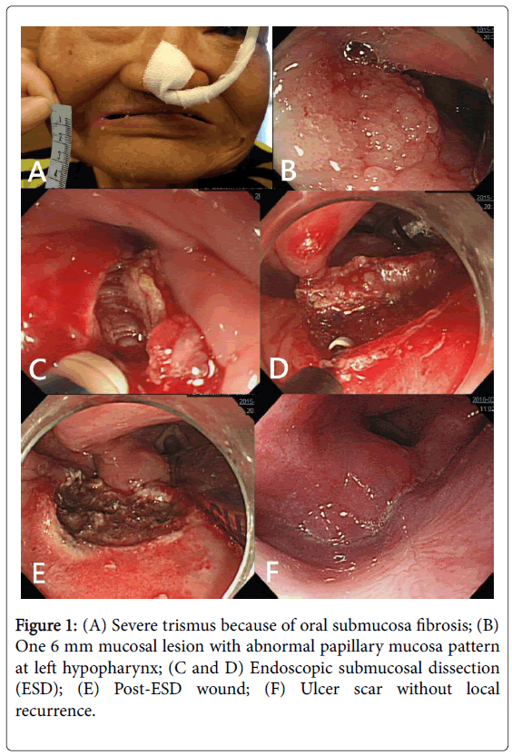 gastrointestinal-digestive-system-Severe-trismus-because