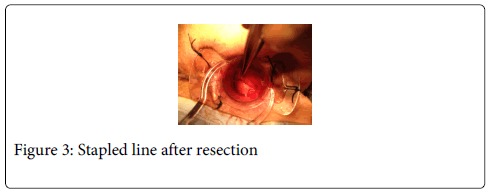 gastrointestinal-digestive-system-Stapled-line