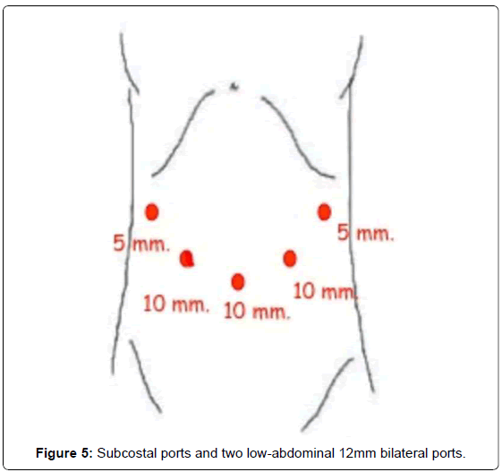 gastrointestinal-digestive-system-Subcostal-ports
