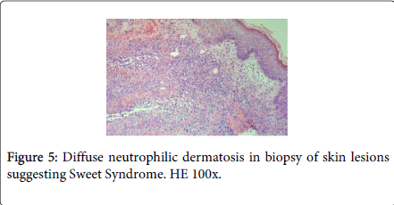 gastrointestinal-digestive-system-Sweet-Syndrome