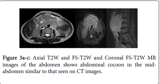 gastrointestinal-digestive-system-abdominal-cocoon