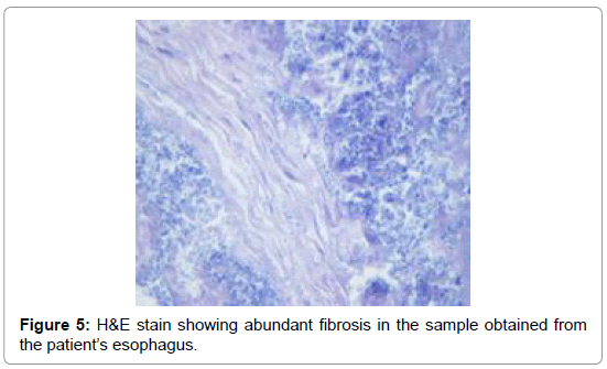 gastrointestinal-digestive-system-abundant-fibrosis