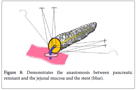 gastrointestinal-digestive-system-anastomosis