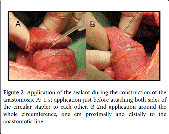 gastrointestinal-digestive-system-anastomotic-line