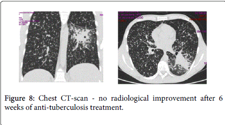 gastrointestinal-digestive-system-anti-tuberculosis