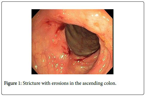 gastrointestinal-digestive-system-ascending-colon