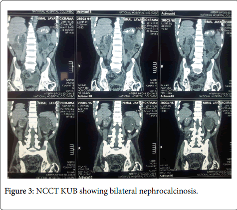 gastrointestinal-digestive-system-bilateral-nephrocalcinosis