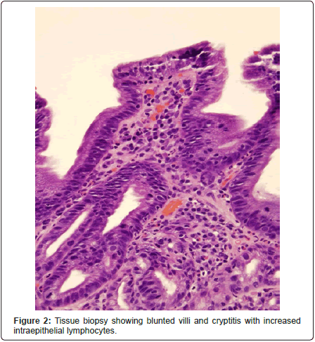 gastrointestinal-digestive-system-blunted-villi