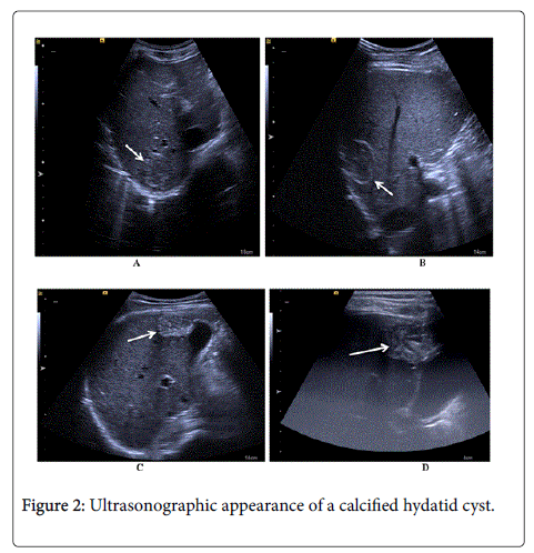 gastrointestinal-digestive-system-calcified-hydatid-cyst
