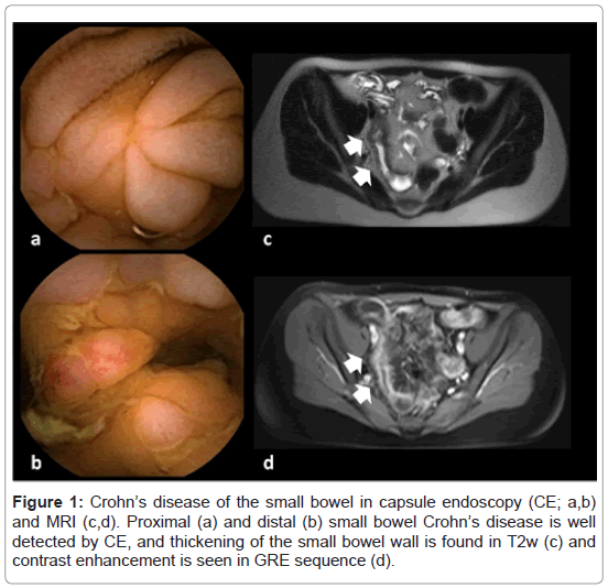 gastrointestinal-digestive-system-capsule-endoscopy